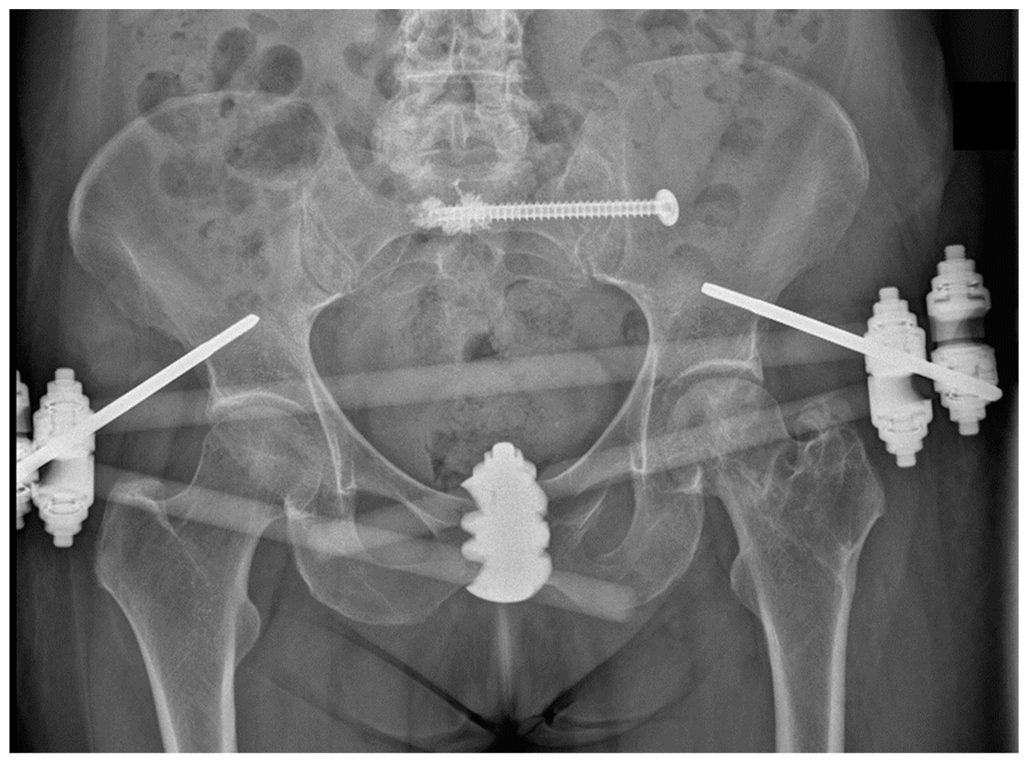 vidnesbyrd afspejle Frugtgrøntsager Medicina | Free Full-Text | Does Cement Augmentation of the Sacroiliac  Screw Lead to Superior Biomechanical Results for Fixation of the Posterior  Pelvic Ring? A Biomechanical Study
