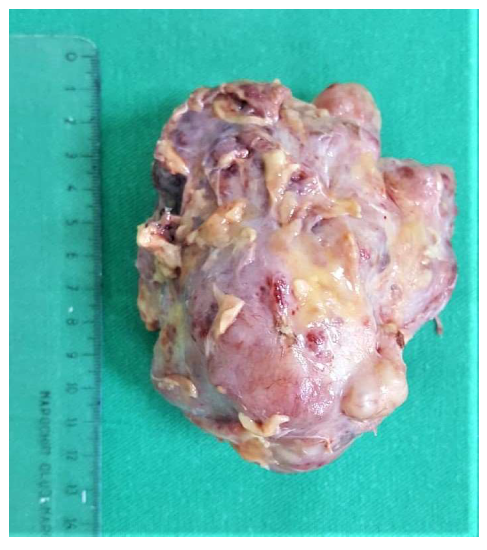 Medicina Free Full-Text Malignant Phyllodes Tumor of the Breast and Pregnancy A Rare Case Report and Literature Review