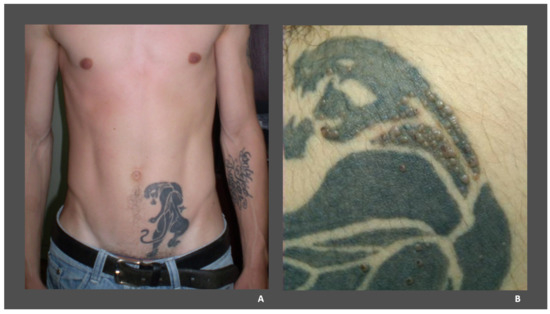 100% Best Laser Tattoo Removal in Chennai | Soul Skin Clinic