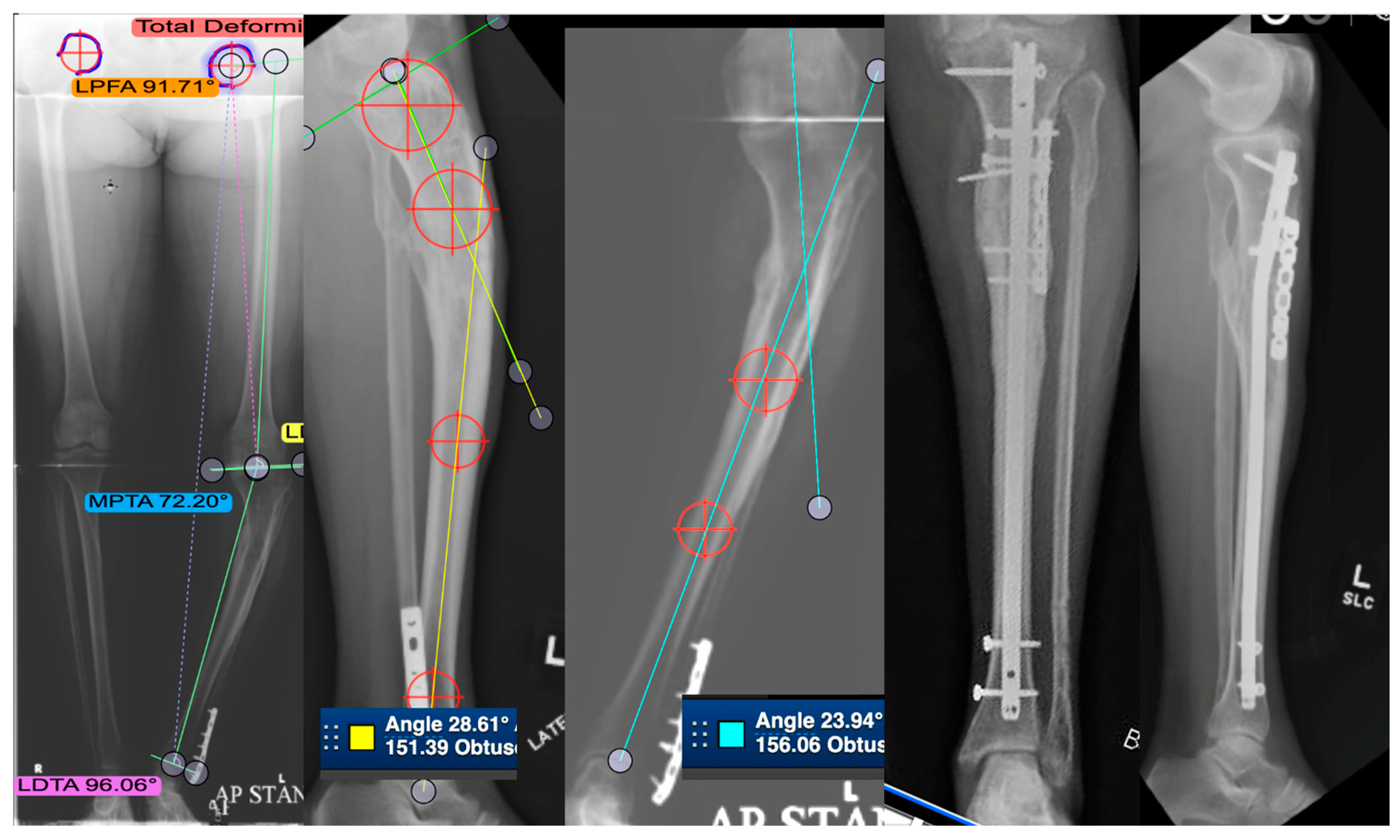 Medicina | Free Full-Text | Malunion of the Tibia: A Systematic Review