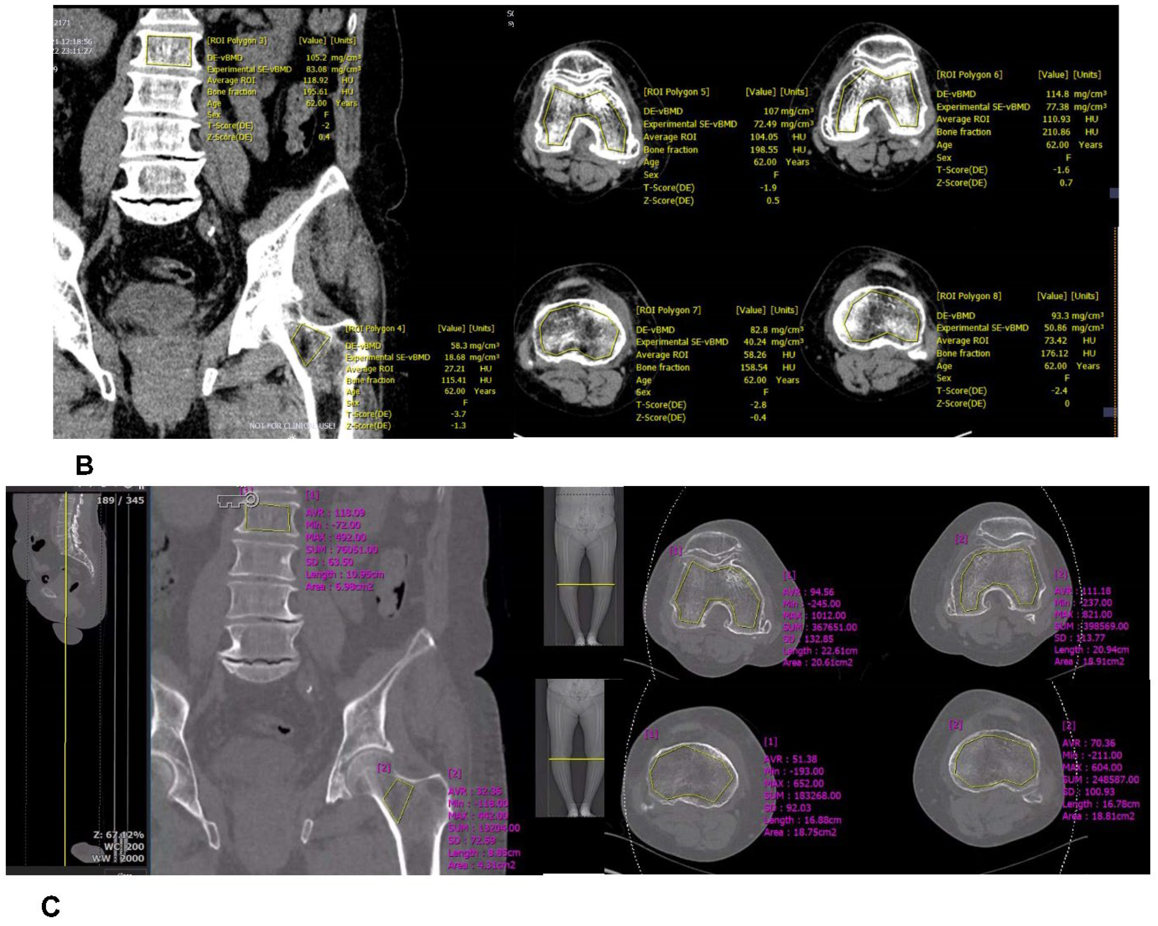 Medicina | Free Full-Text | Dual-Energy CT-Based Bone Mineral 