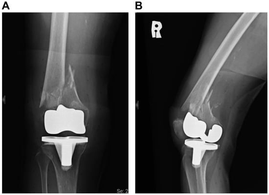 Successful Plate Fixation with Long Intramedullary Fibula Bone Graft ...