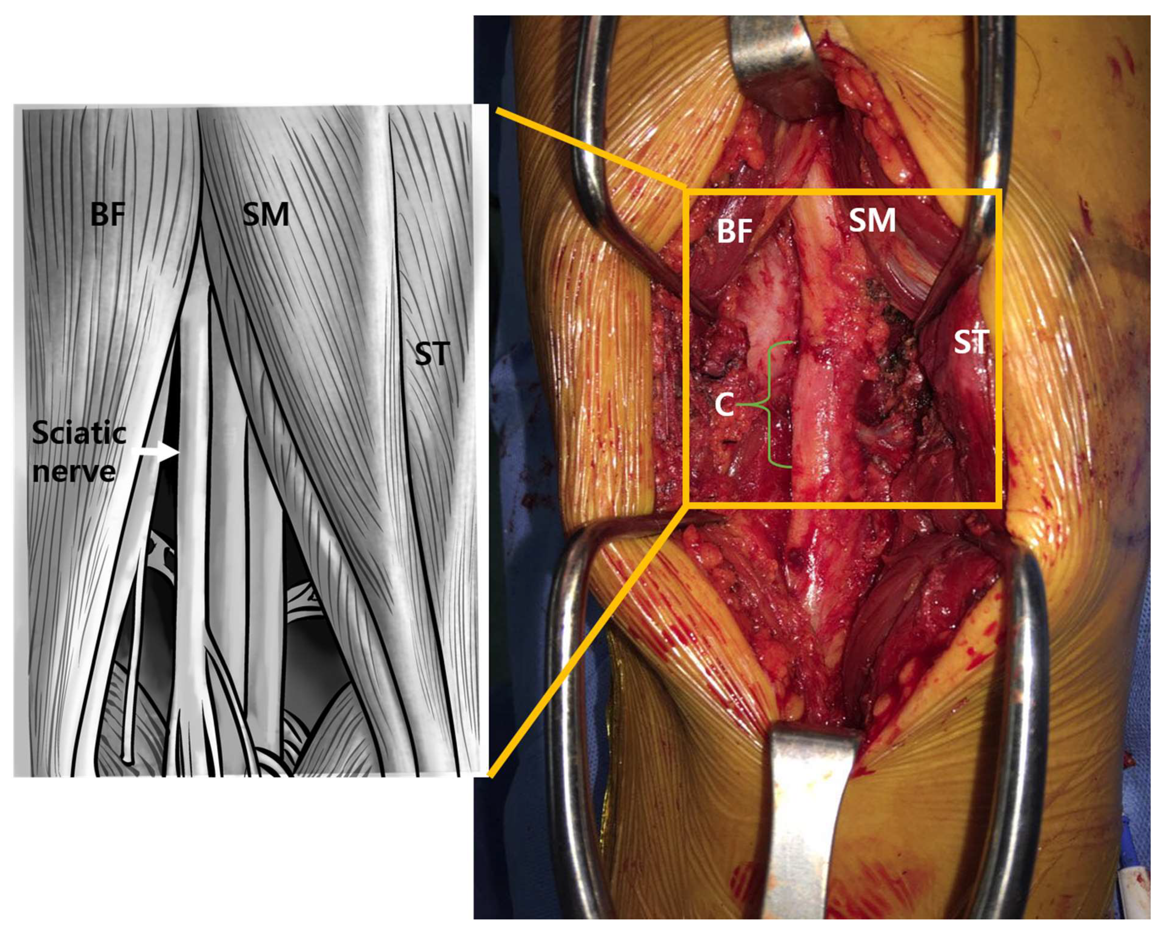 Sciatic Nerve Decompression: Background, Indications, Technical  Considerations