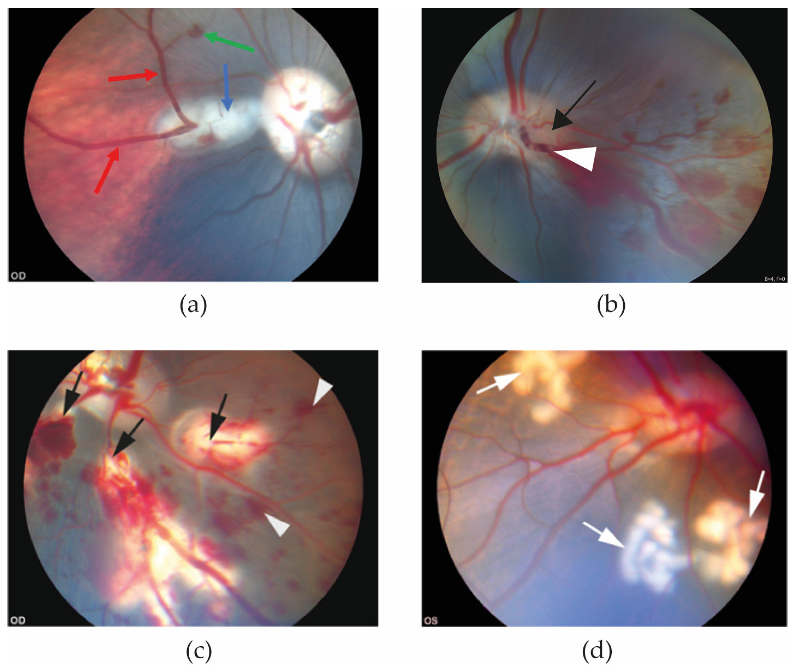 Medicina | Free Full-Text | Laser-Induced Porcine of Retinal Vein Occlusion: An Optimized Reproducible Approach