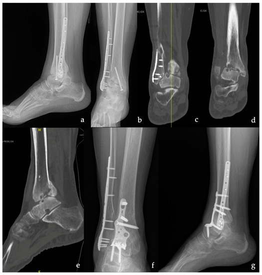 Outcomes of Primary Tibiotalocalcaneal Nailing for Complicated Diabetic  Ankle Fractures - M Pierce Ebaugh, Benjamin Umbel, Benjamin Taylor, David  Goss, 2019