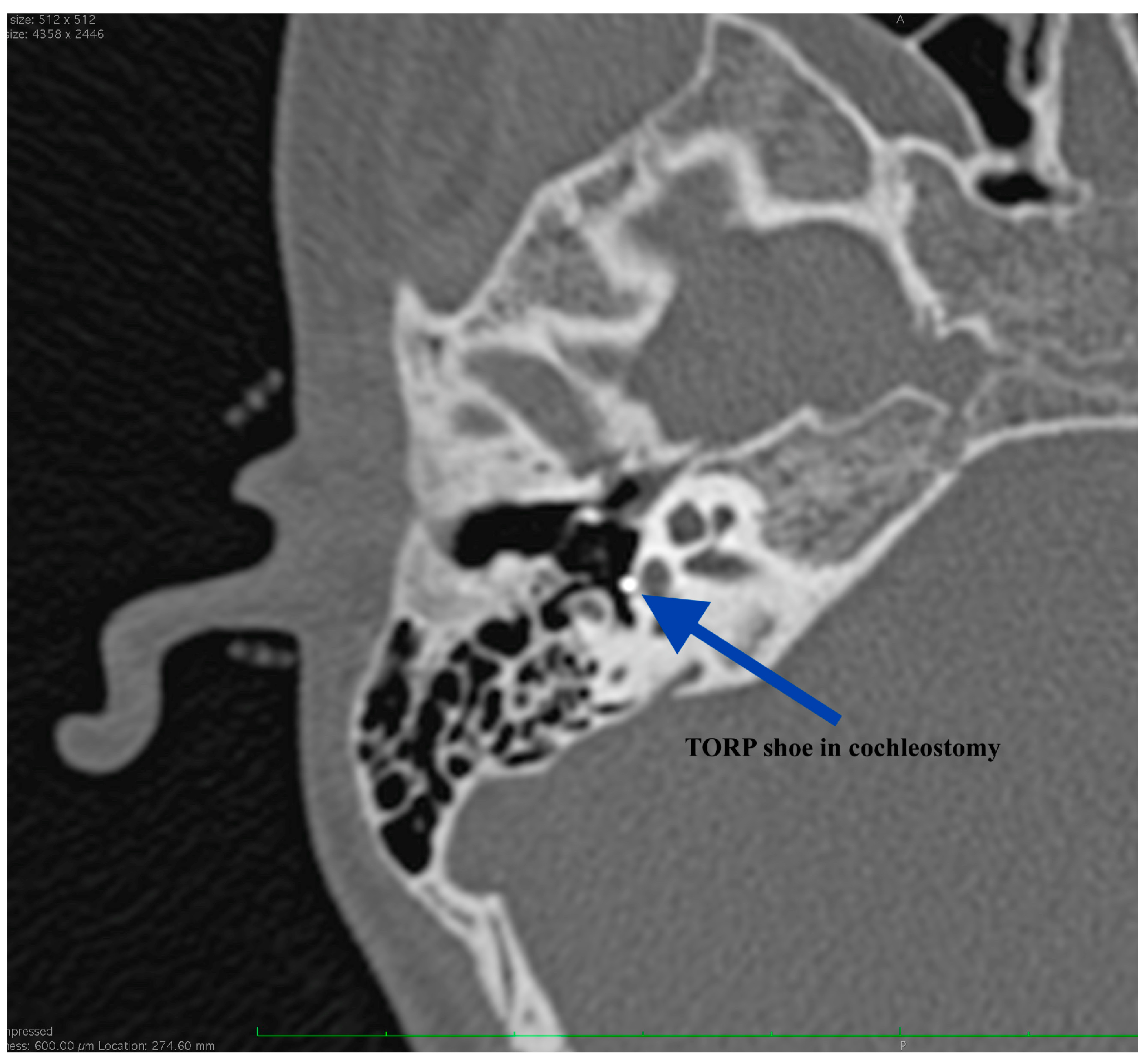 Stapes, Radiology Reference Article