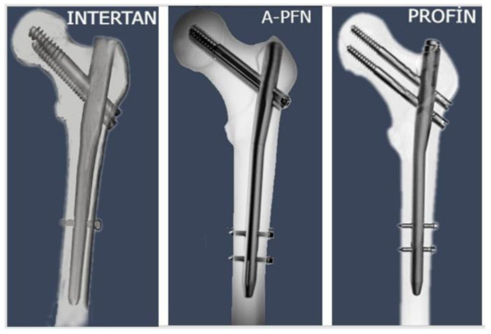 Insufficient proximal medullary filling of cephalomedullary nails in intertrochanteric  femur fractures predicts excessive postoperative sliding: a case–control  study | BMC Musculoskeletal Disorders | Full Text