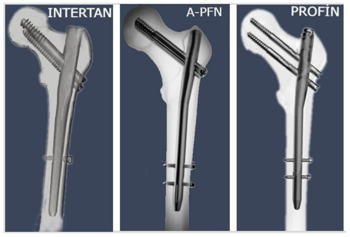 Kit de instrumentos para fractura femoral - Proximal Femoral Nail  Anti-rotation(PFNA) - Health-Joy Medical - personalizable