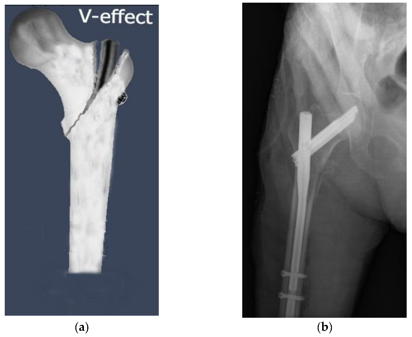 Proximal femoral nail | Radiology Reference Article | Radiopaedia.org