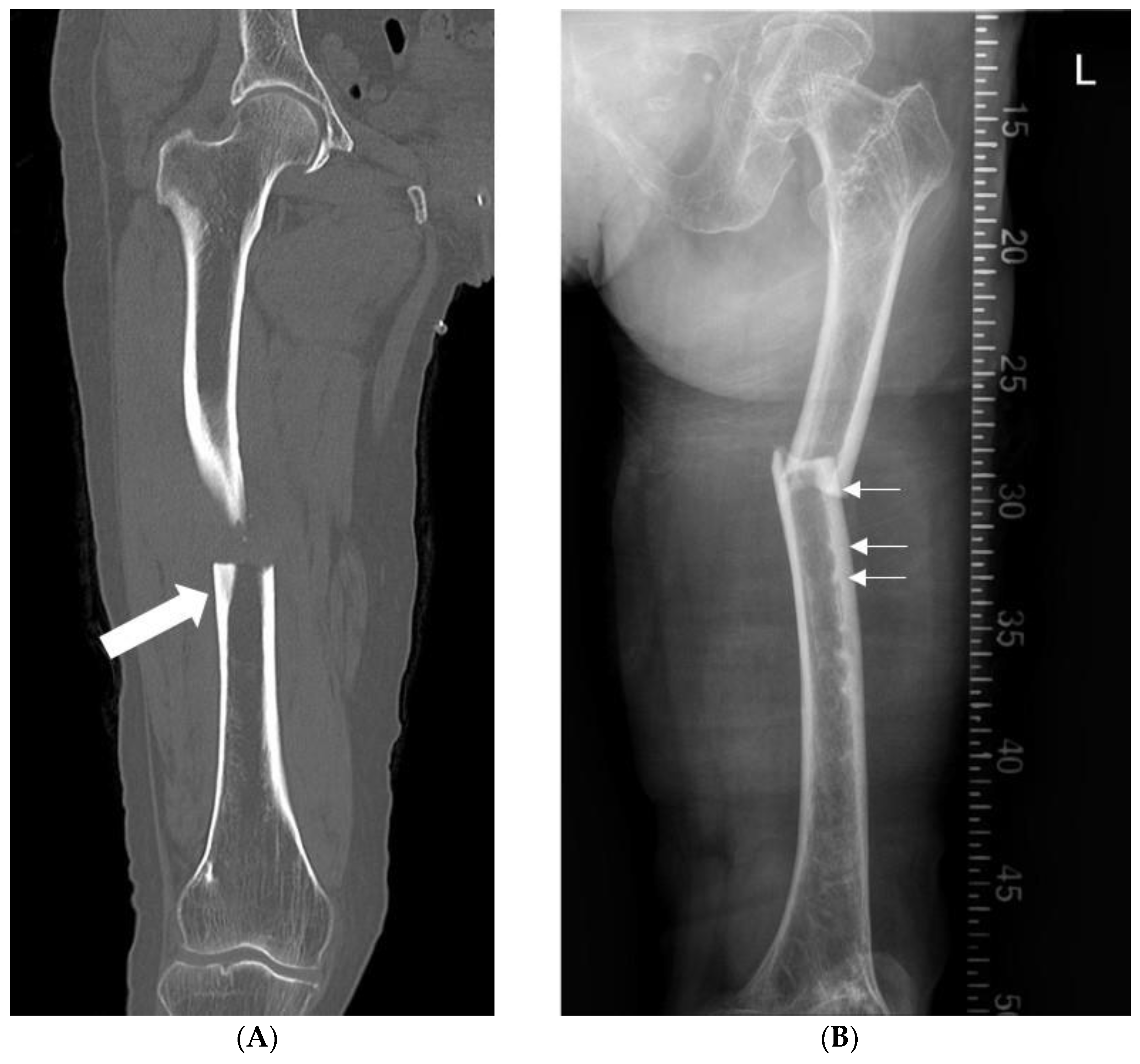 Medicina | Free Full-Text | Risk Factors Associated with Intraoperative  Iatrogenic Fracture in Patients Undergoing Intramedullary Nailing for  Atypical Femoral Fractures with Marked Anterior and Lateral Bowing