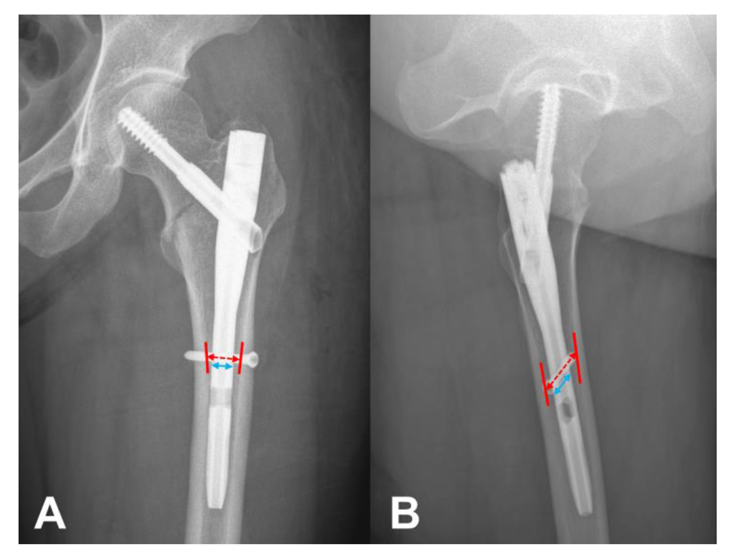 Right Leg Surgical Fixation of Femur Fracture with Placement of Intramedullary  Rod | Doctor Stock