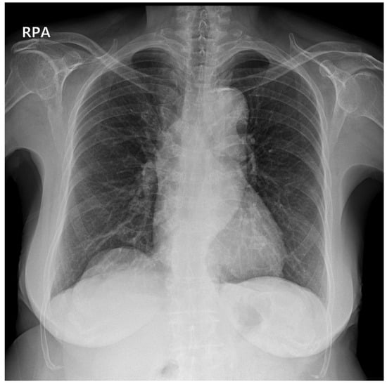 Chest X Ray Mild Pneumothorax