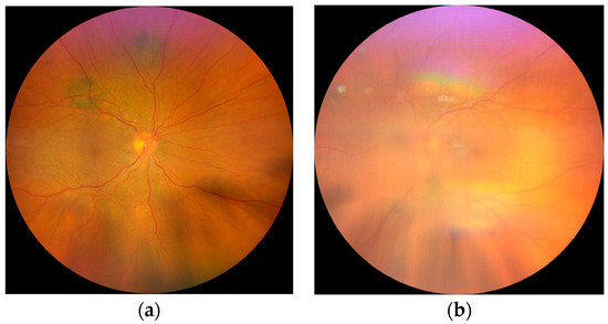 Medicina | Free Full-Text | Management Of Bilateral Diffuse Uveal ...