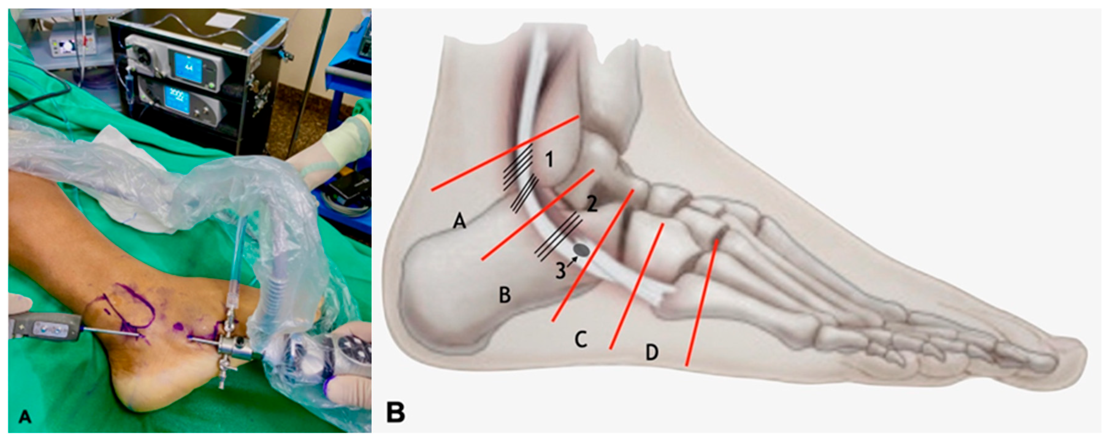 Minimally Invasive Peroneal Tenodesis Assisted By Peroneal Tendoscopy Minimally Invasive Peroneal Tenodesis Assisted By Peroneal Tendoscopy
