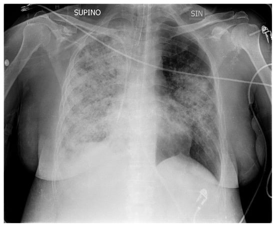 Medicina | Free Full-Text | Cytomegalovirus Pneumonia in a Patient with ...