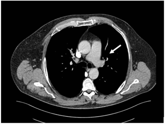 Medicina | Free Full-Text | Venous Thromboembolism in Burn Patients: A ...