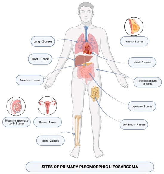 Medicina | Free Full-Text | Pleomorphic Liposarcoma Unraveled ...