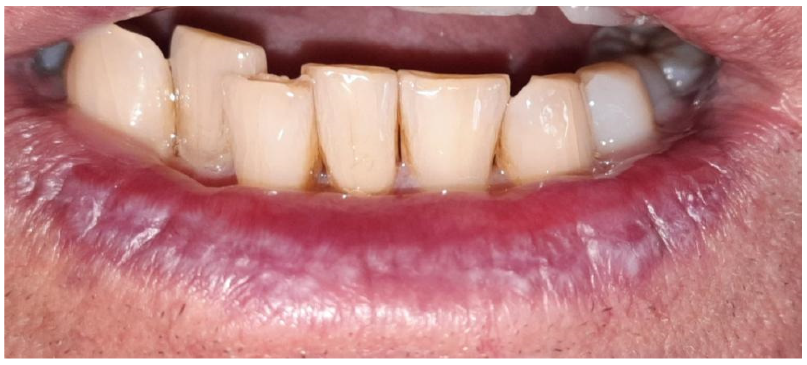 Lichen Planus Of The Lip—case Series And Review Of The Literature