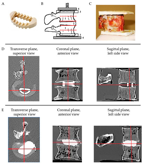 Medicina | Free Full-Text | Biomechanical Behavior of Injected Cement ...