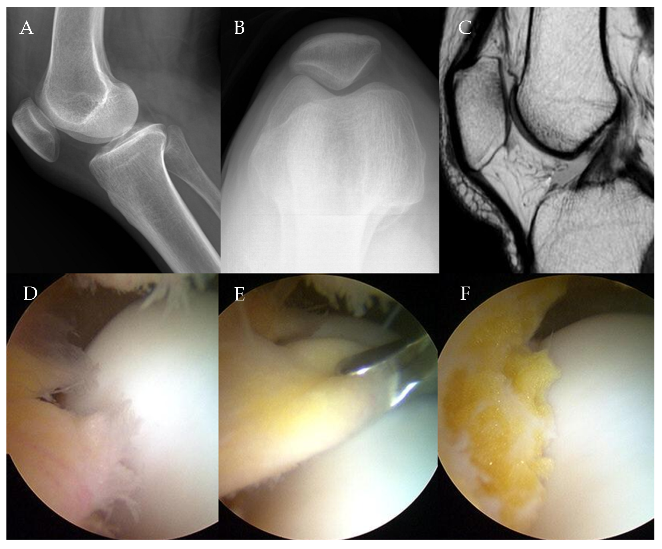 Arthroscopic Resection Of Infrapatellar Fat Pad Impingement Syndrome Arthroscopic Resection Of Infrapatellar Fat Pad Impingement Syndrome