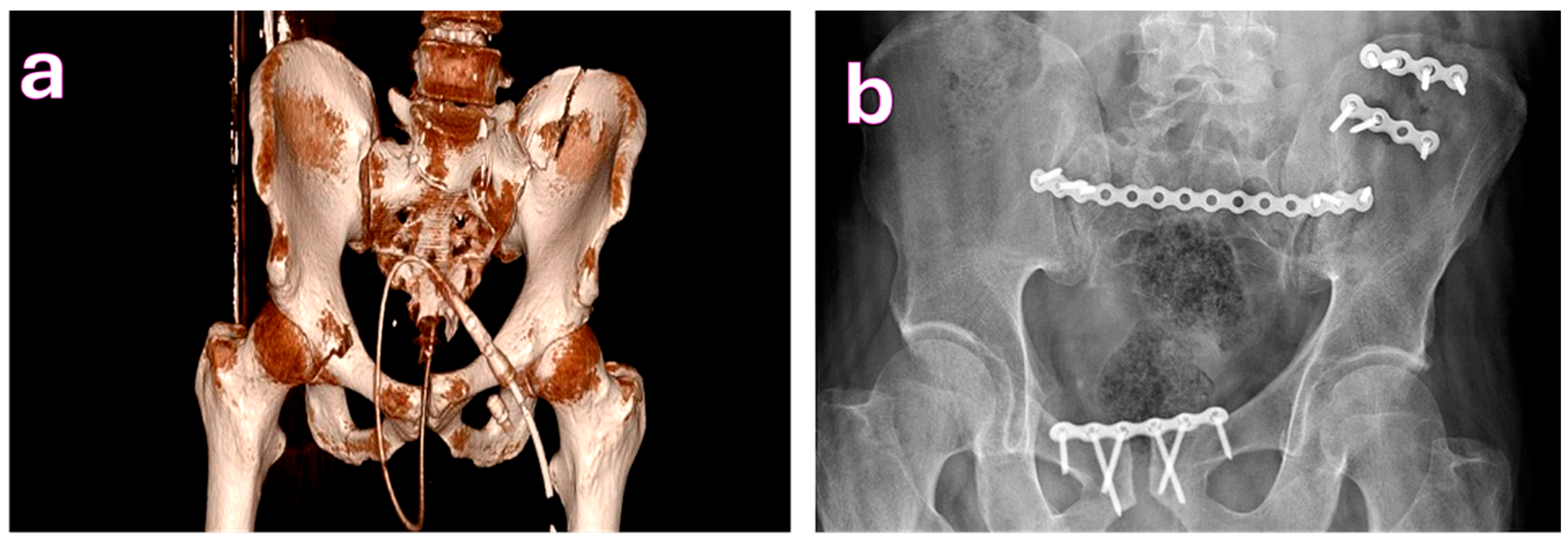 The PEARL Score for Predicting Postoperative Complication Risk in