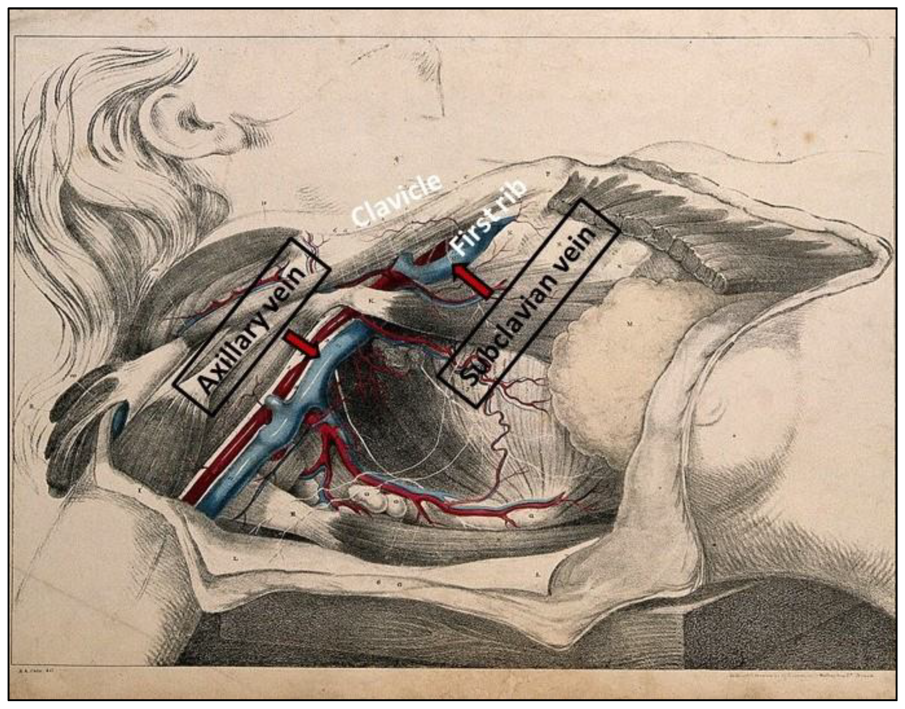 Axillary Versus Subclavian Venous Access for Permanent Pacemaker ...
