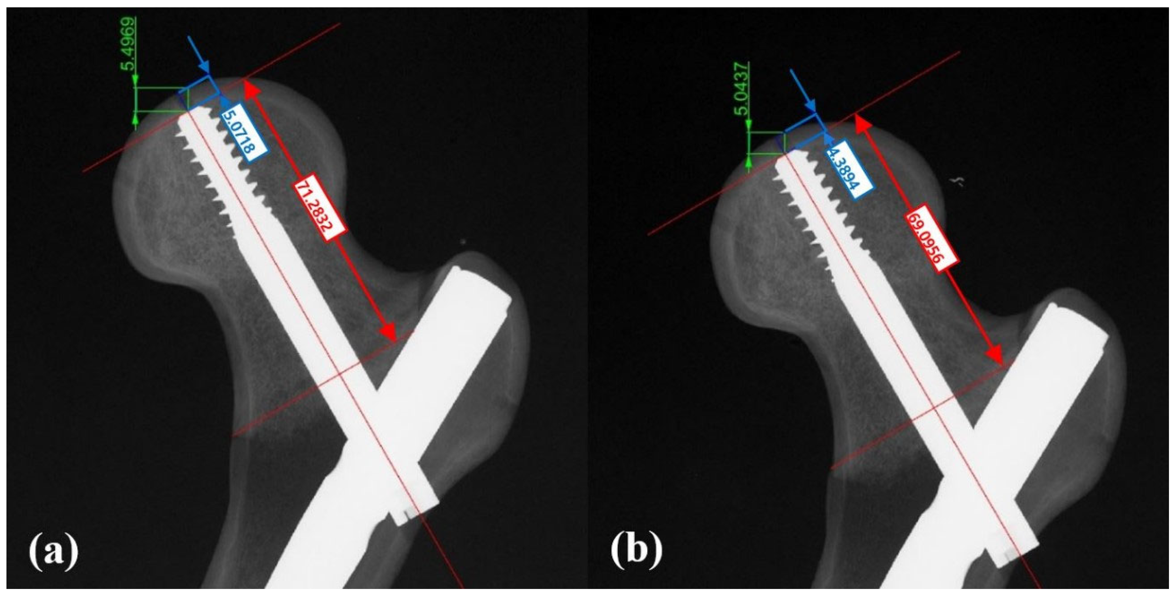 Biomechanical Comparison of Three Different Fixation Methods for ...