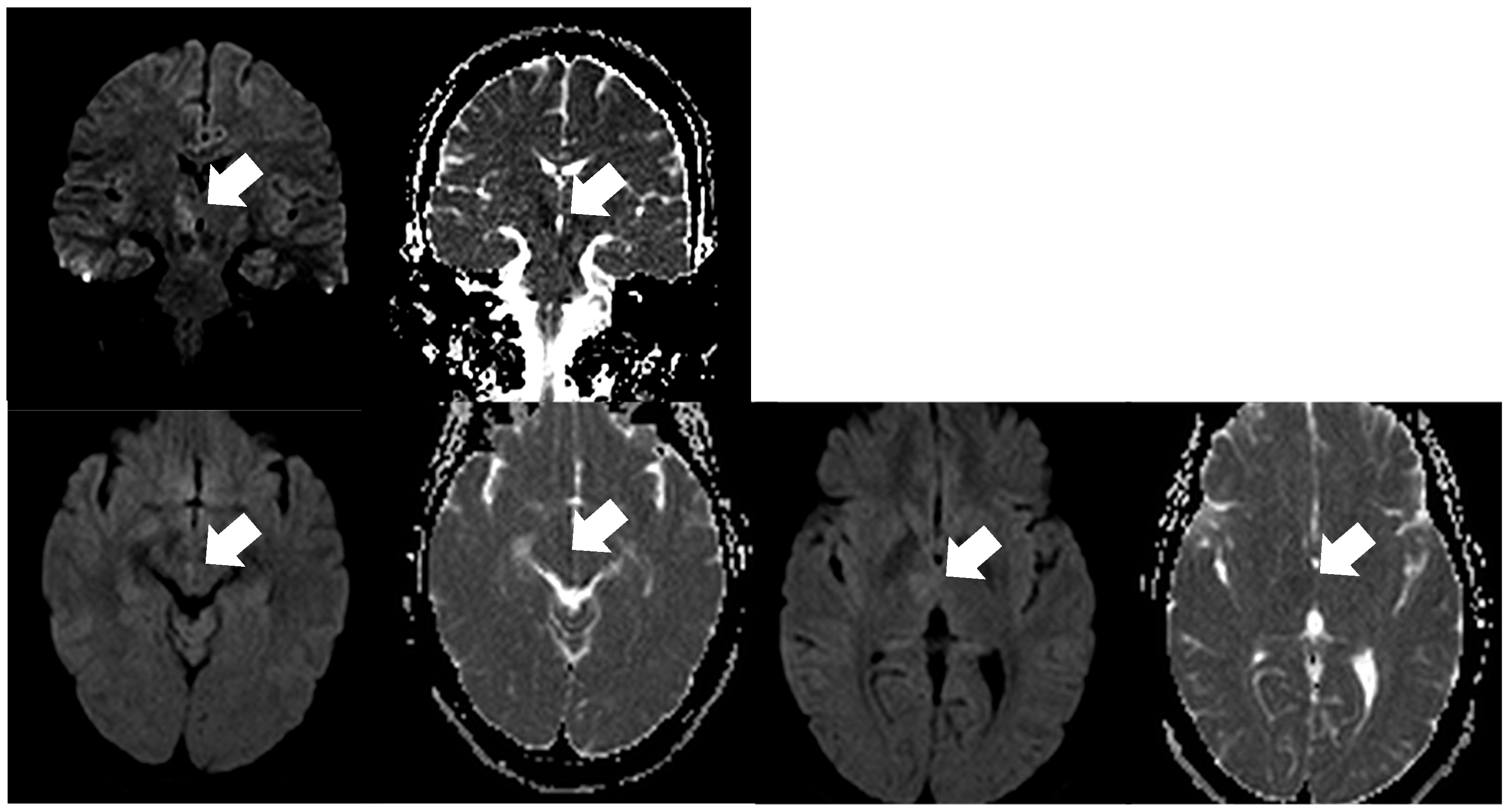 Added Value of Thin-Section Coronal DWI for Lesion Visualization in ...