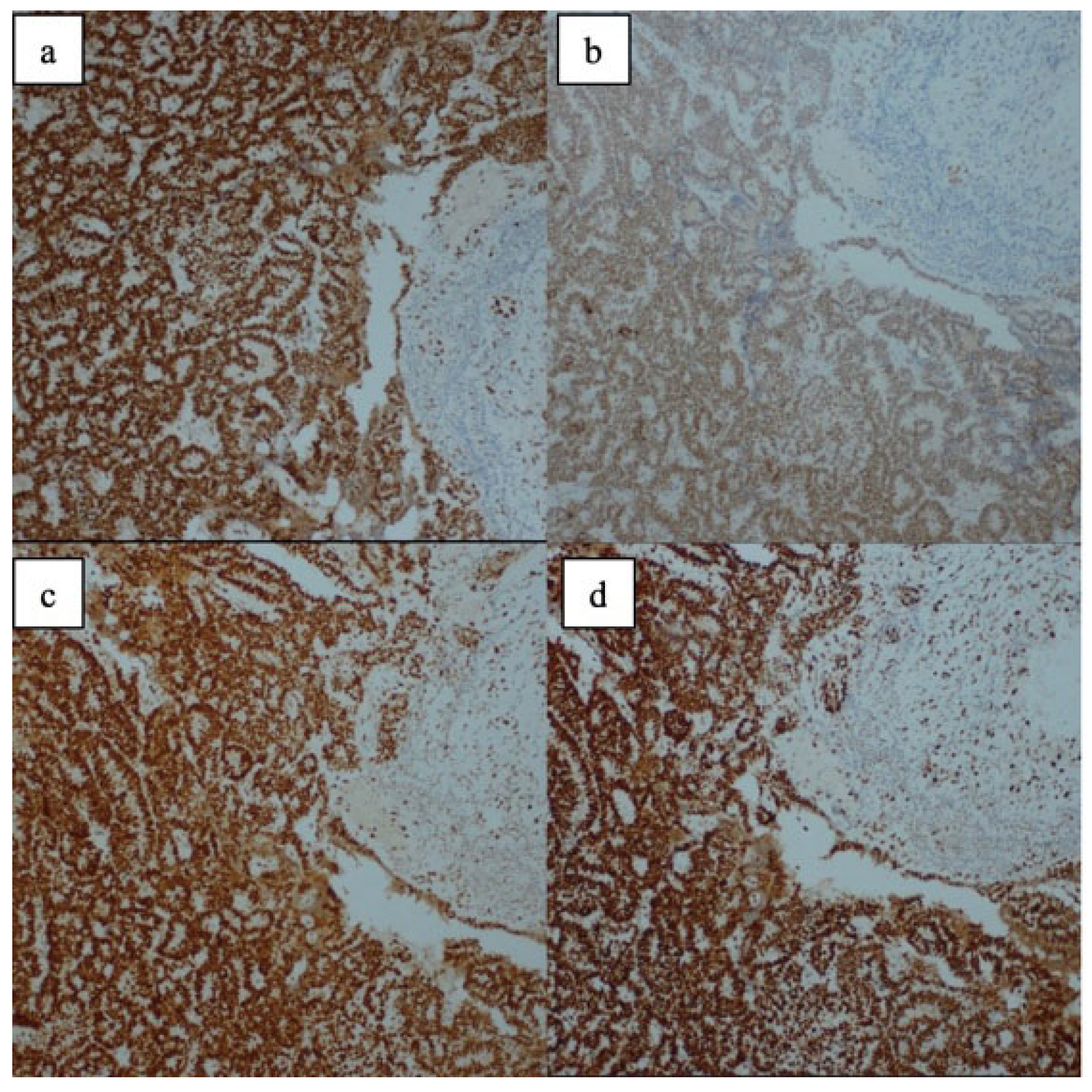 Immunohistochemical Changes in MMR Status, ER/PR, and p53 Expression in ...