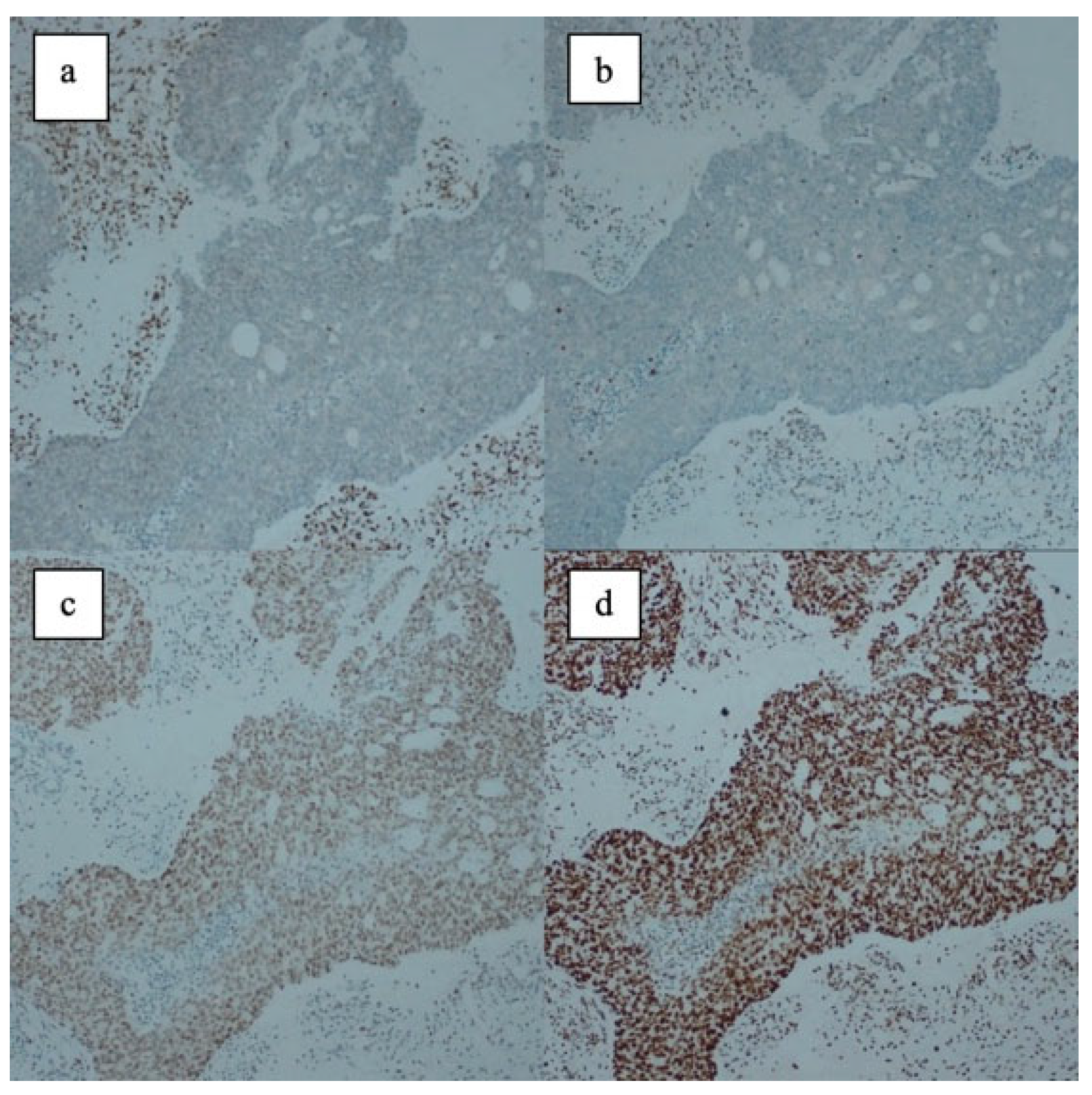 Immunohistochemical Changes in MMR Status, ER/PR, and p53 Expression in ...