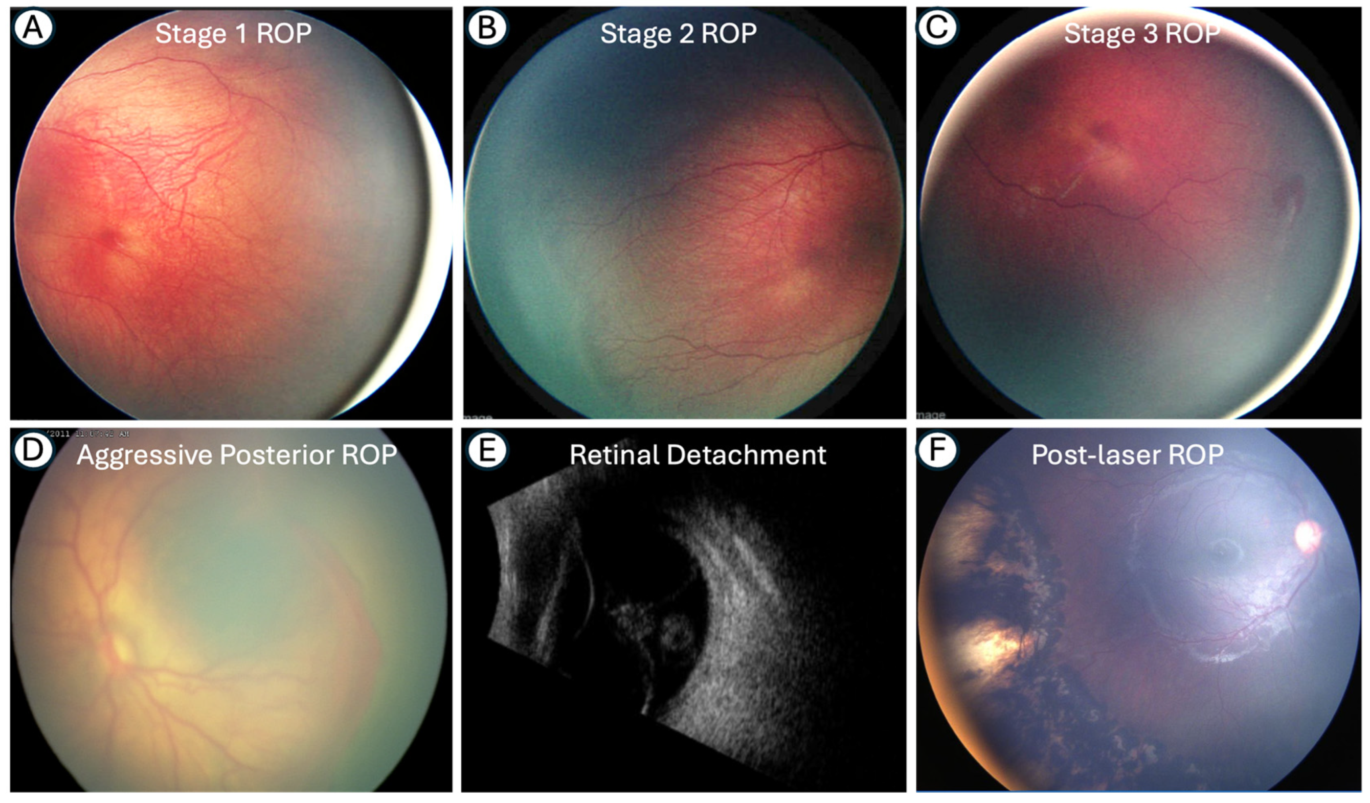 Optomed Rop Retinopathy of Prematurity (ROP): Are We There Yet?