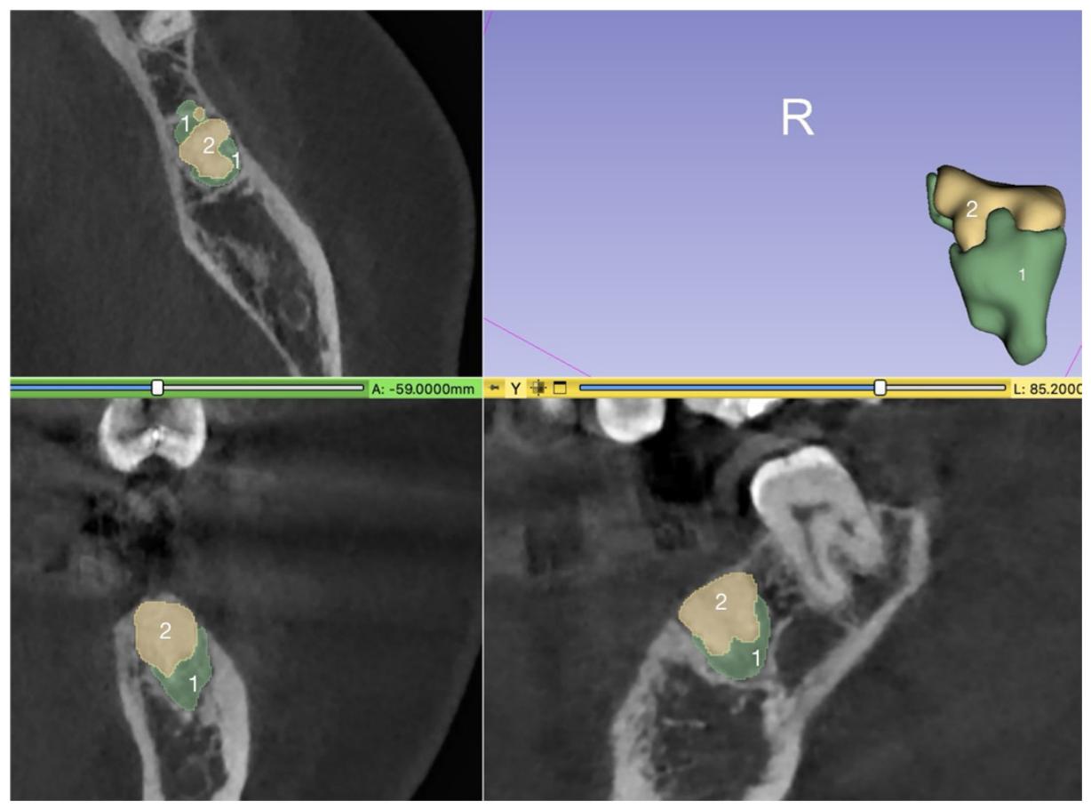Volumetric Analysis of Ridge Preservation Using Bio-Oss® Collagen: A ...