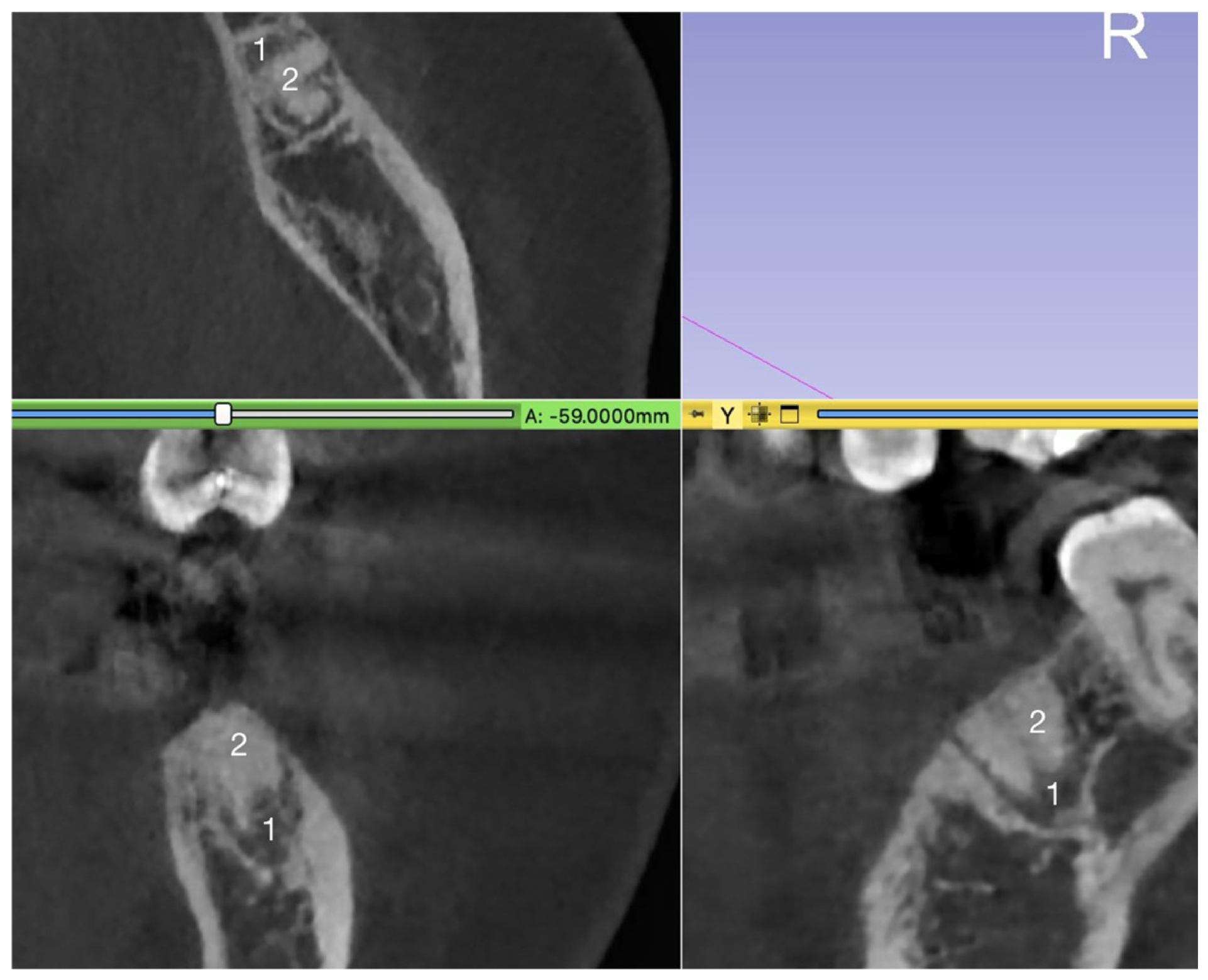 Volumetric Analysis of Ridge Preservation Using Bio-Oss® Collagen: A ...