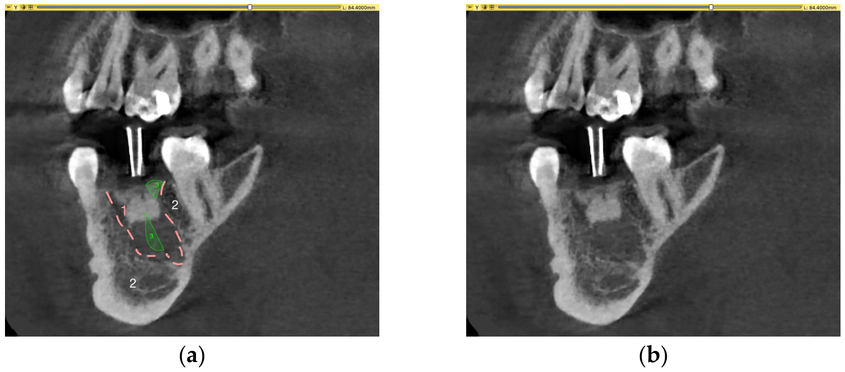 Volumetric Analysis of Ridge Preservation Using Bio-Oss® Collagen: A ...