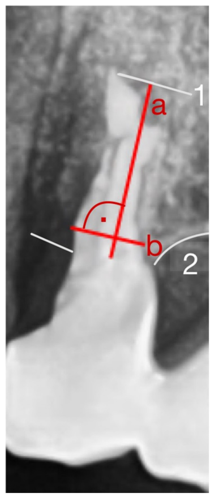Volumetric Analysis of Ridge Preservation Using Bio-Oss® Collagen: A ...