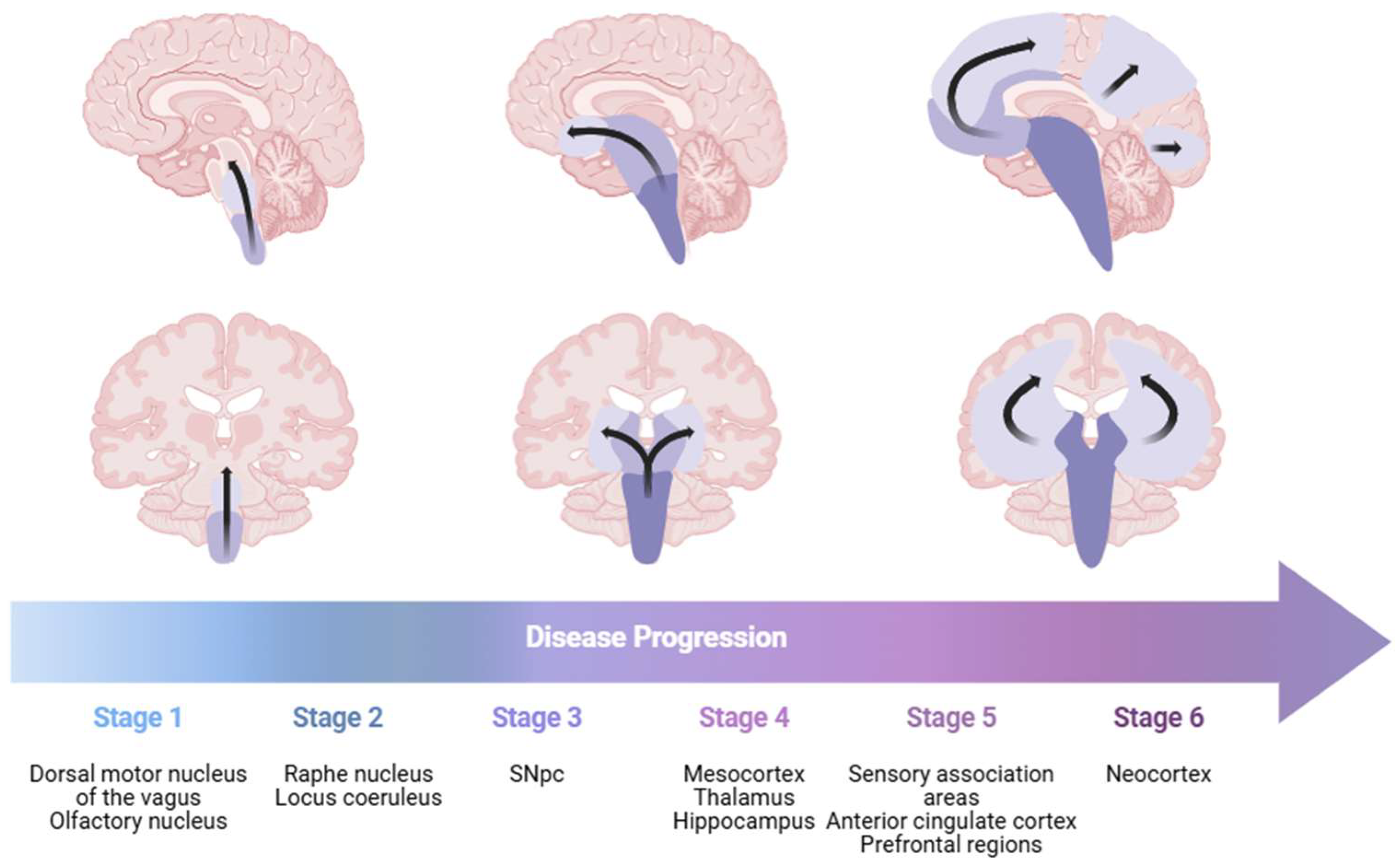 “Brain-First” vs. “Body-First” PD: Definitions and Implications in ...