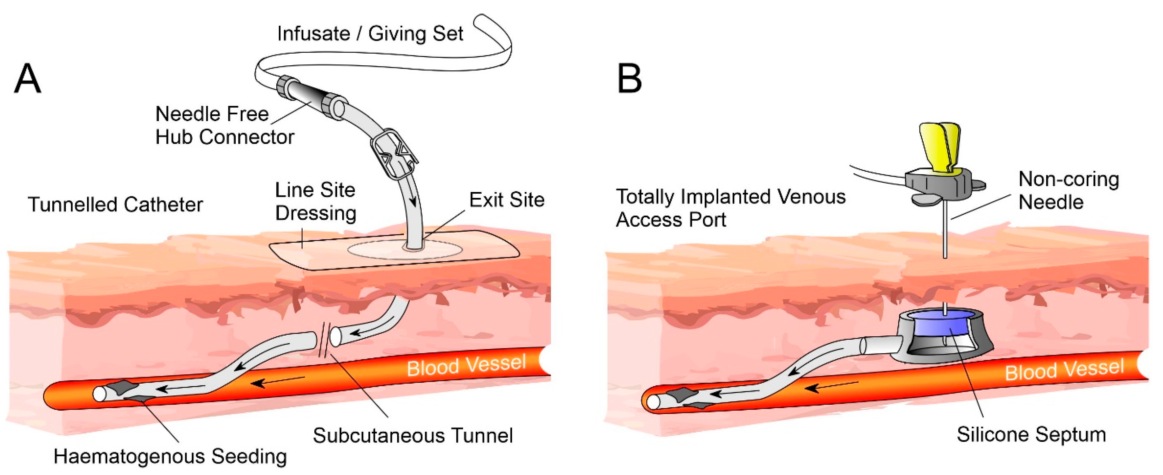 Broviac Tunneled Catheter Broviac Tunneled Catheter