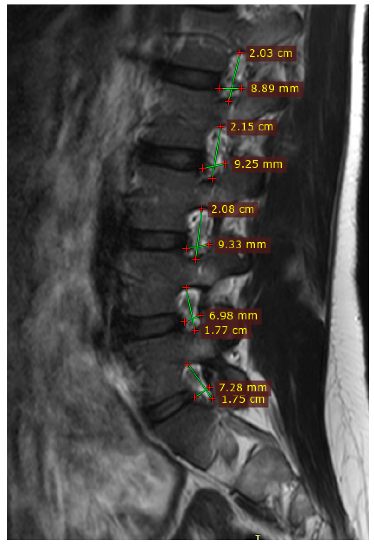 Medical Sciences | Free Full-Text | Quantifying Lumbar Foraminal ...