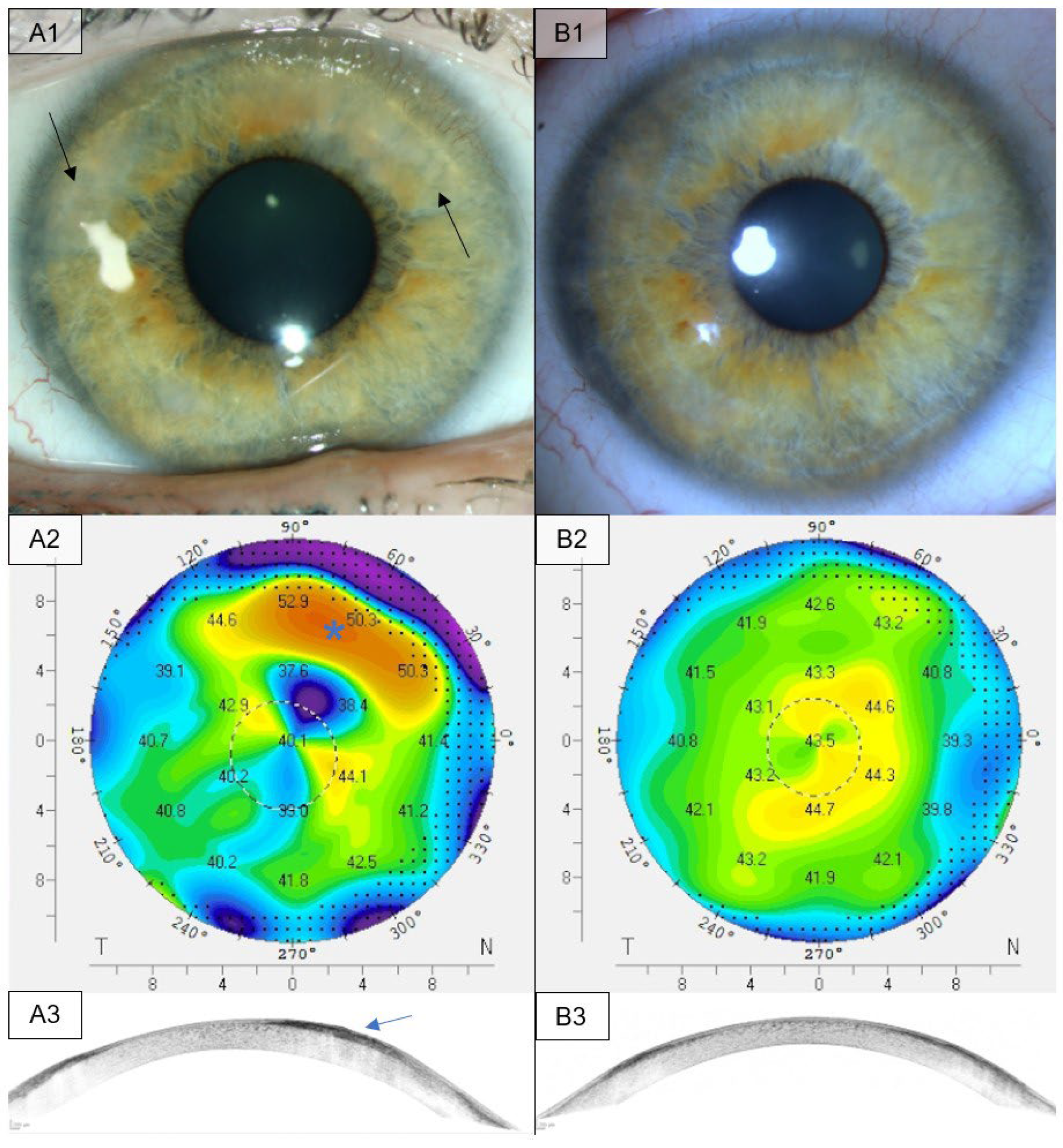 Visual Topographic And Aberrometric Outcomes After Phototherapeutic Visual Topographic And Aberrometric Outcomes After Phototherapeutic