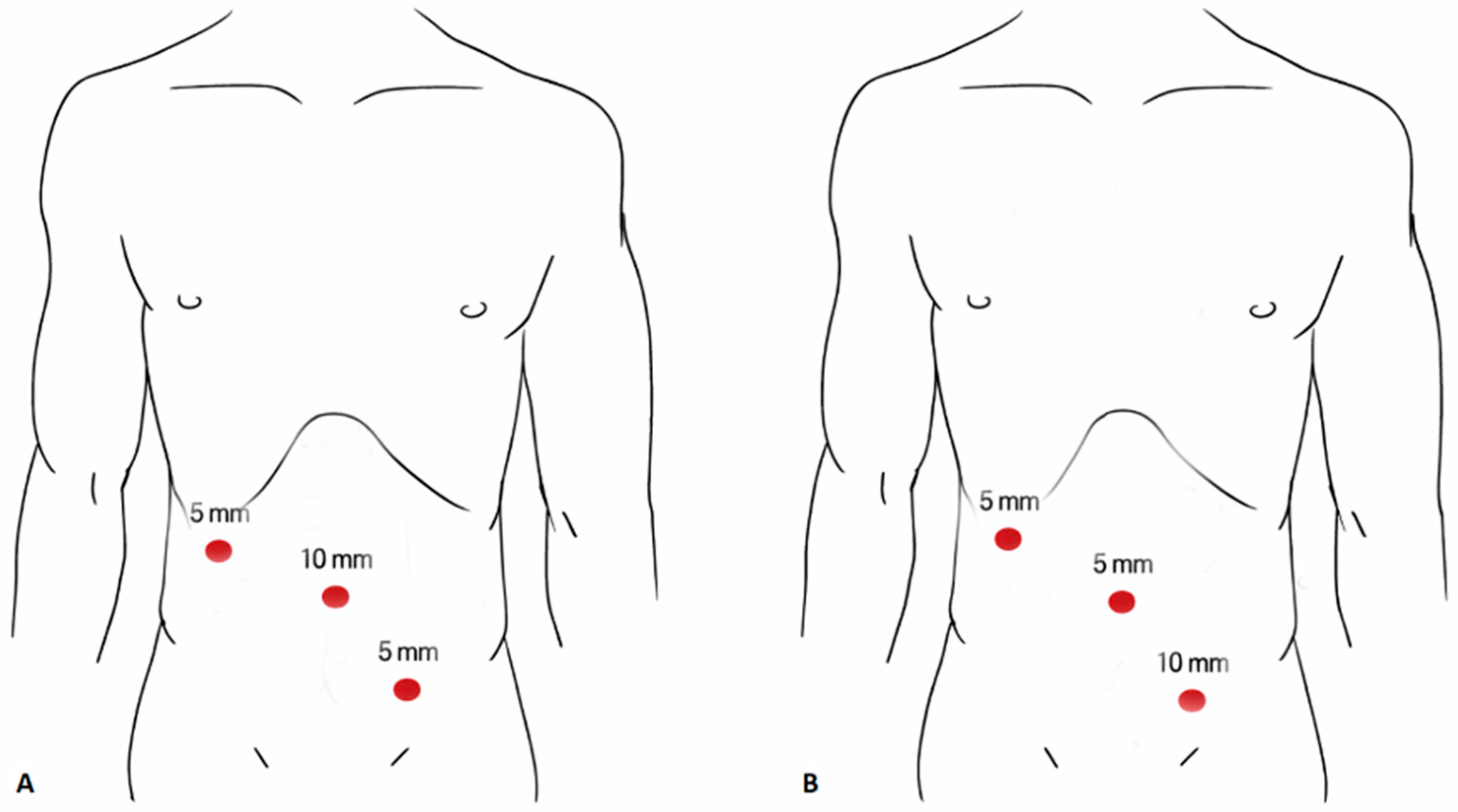 Impact of Trocar Position on Surgical Site Infection After Pediatric ...