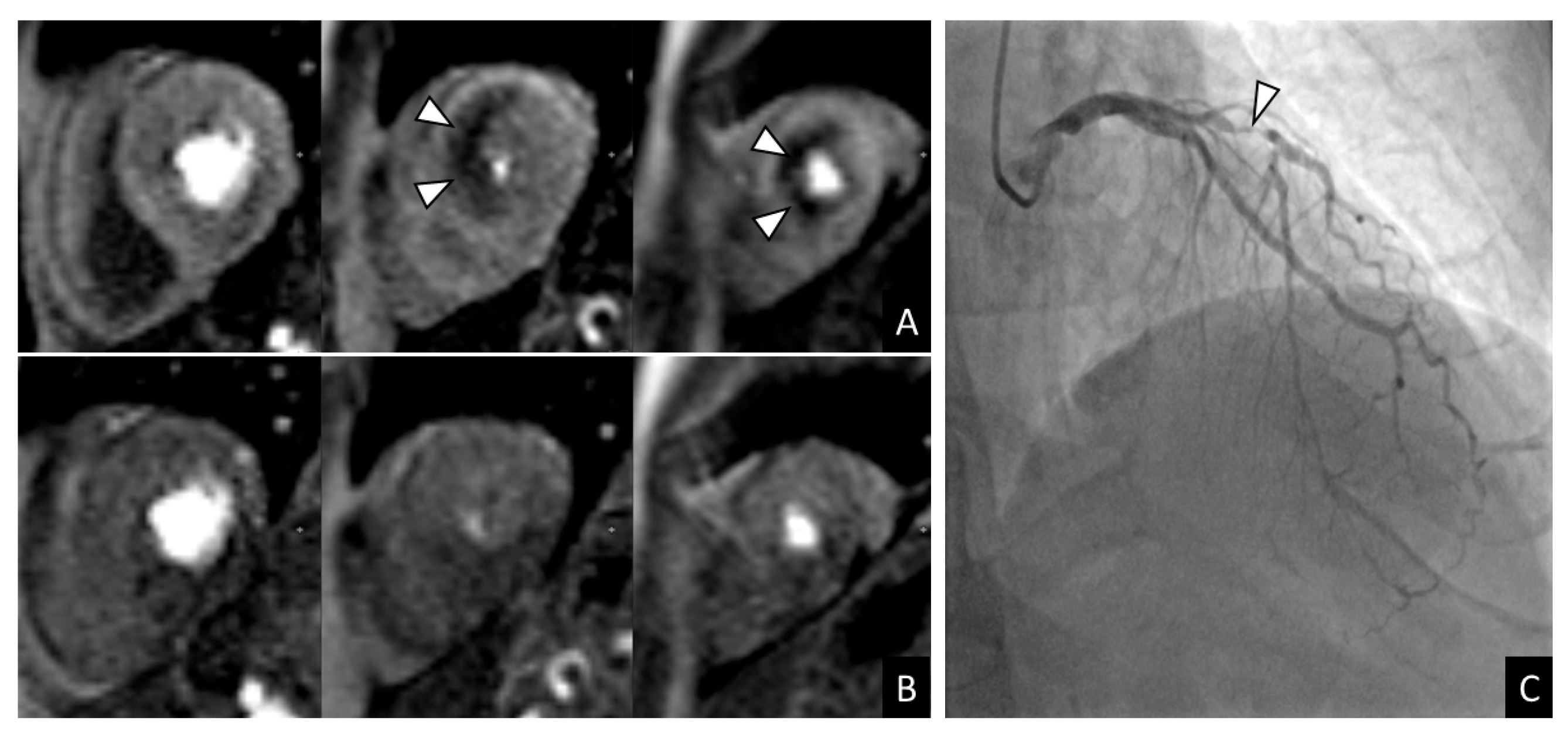 Prognostic Value of Regadenoson Stress Perfusion CMR