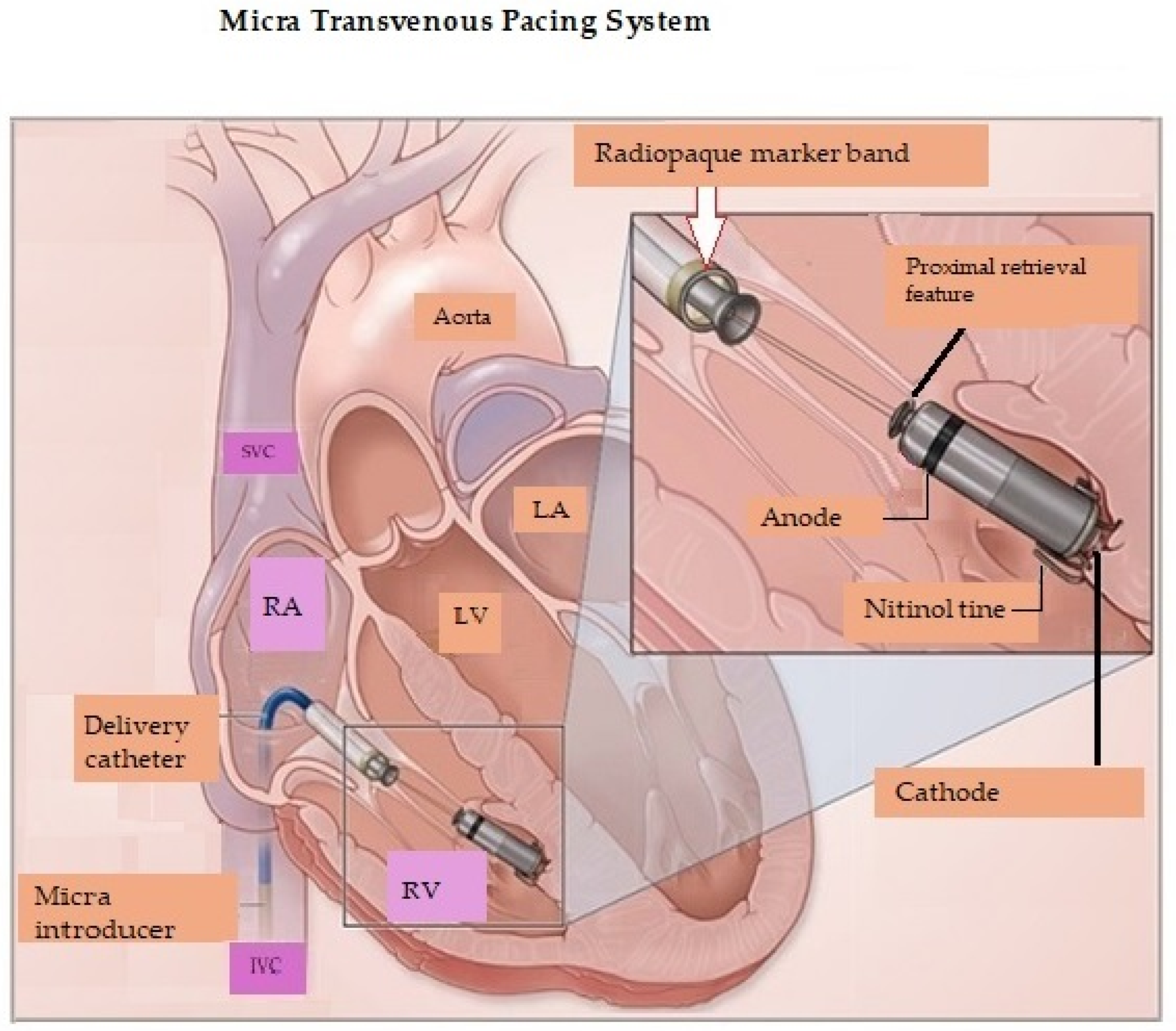Leadless Pacing Current Status And Ongoing Developments Leadless Pacing Current Status And Ongoing Developments