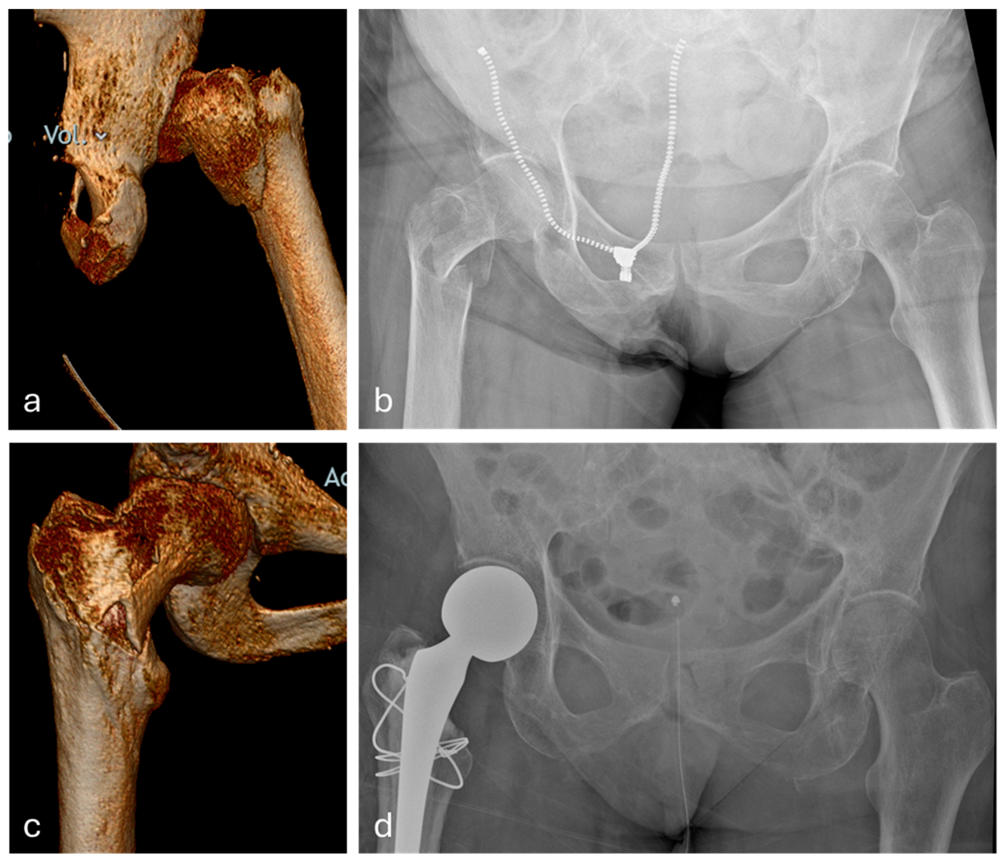 A Novel Combined Soft Tissue and Bony Repair of Trochanteric Fractures ...