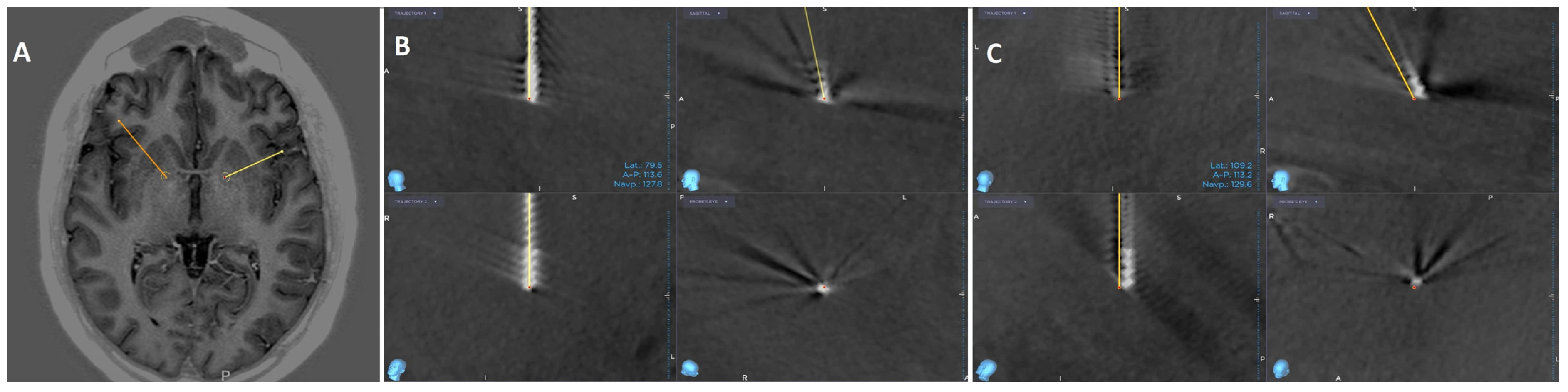 Anteromedial Globus Pallidus Internus Deep Brain Stimulation for Gilles ...