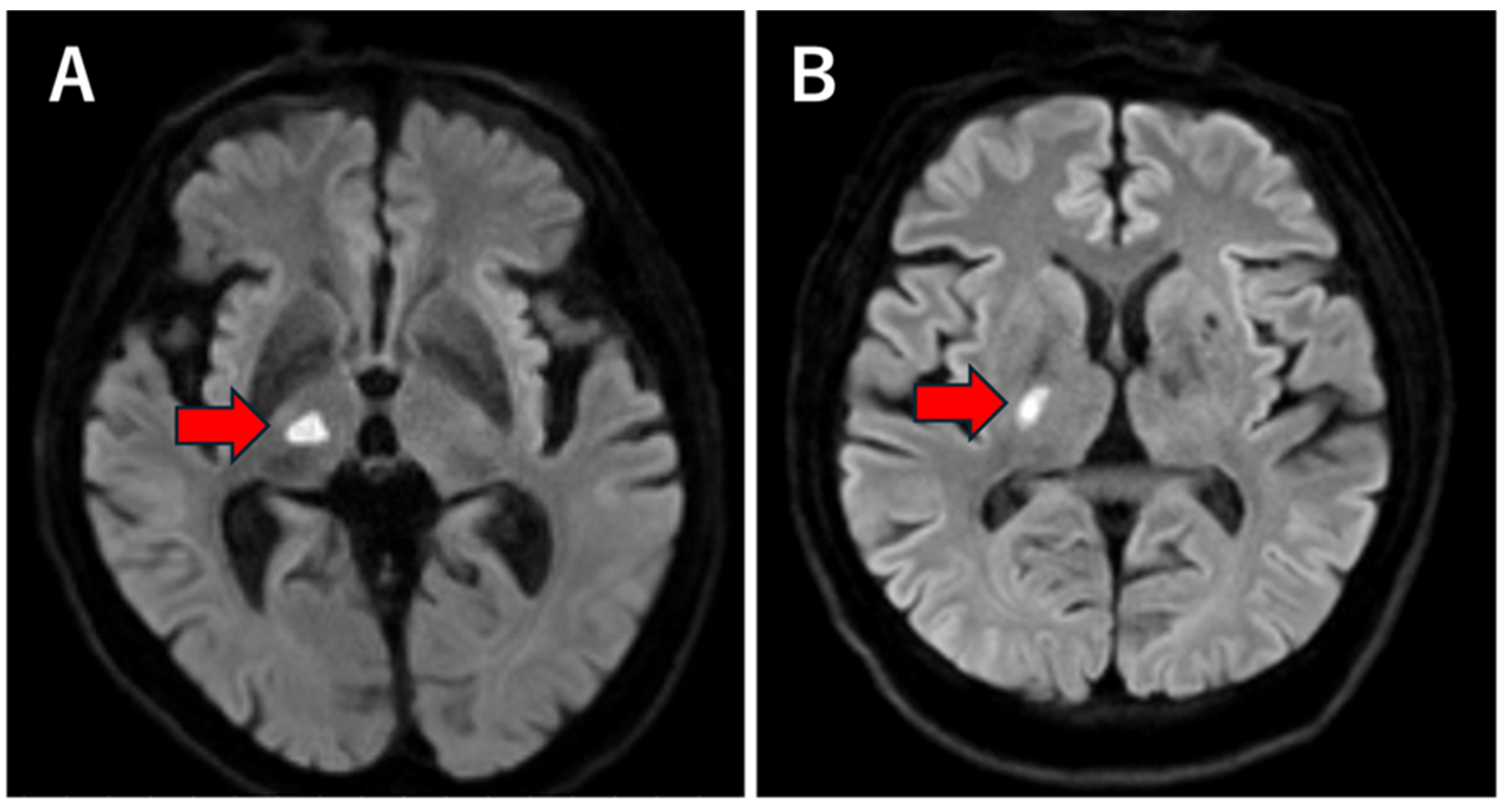 Perforator Infarction Posterior Communicating Artery Configuration and Laterality of Thalamic ...