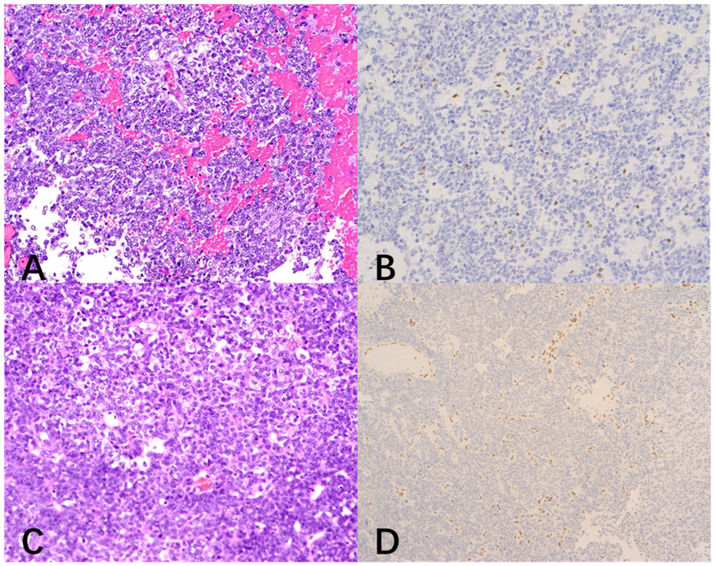 Lft Pattern Rhabdo Atypical Teratoid/Rhabdoid Tumor of the Lateral Ventricle: A Case ...