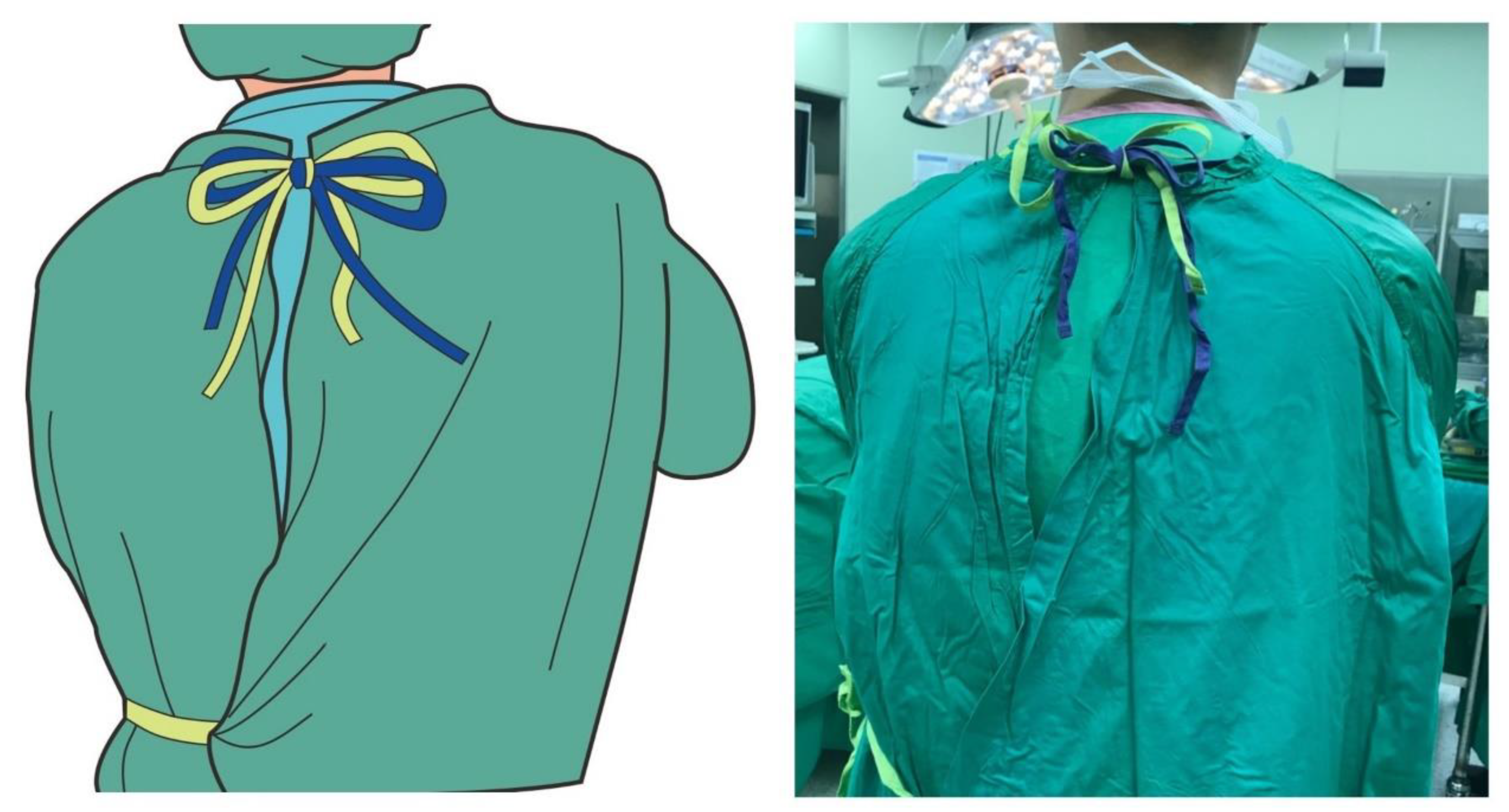 Nursing Reports | Free Full-Text | A Combined Tie-Fastening Method for the Reusable  Surgical Gown with Two Neck Tie Belts to Improve Wearing Comfort