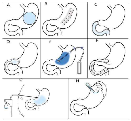 Nutrients | Free Full-Text | Endoscopic Treatment Of Obesity And ...