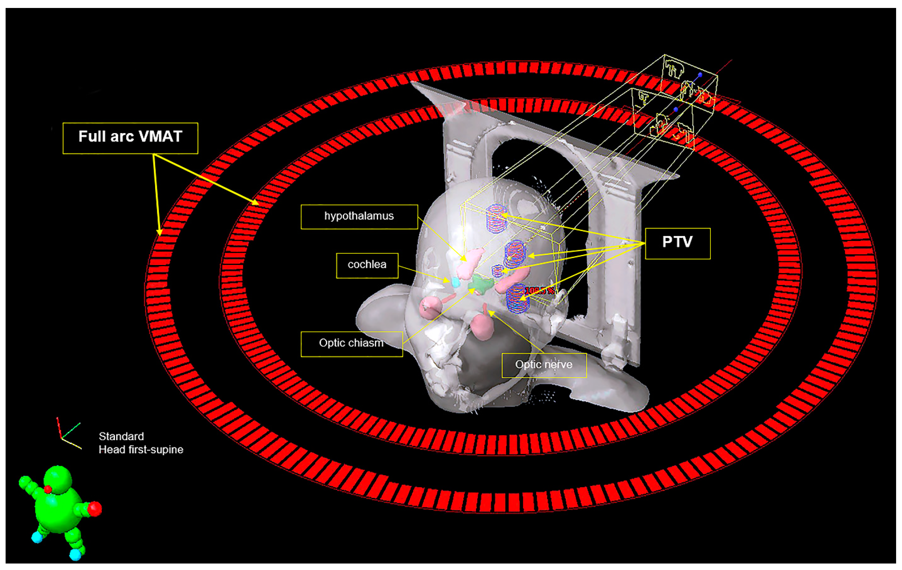 Fractionated Volumetric Modulated Arc Therapy FVMAT For Fractionated Volumetric Modulated Arc Therapy FVMAT For