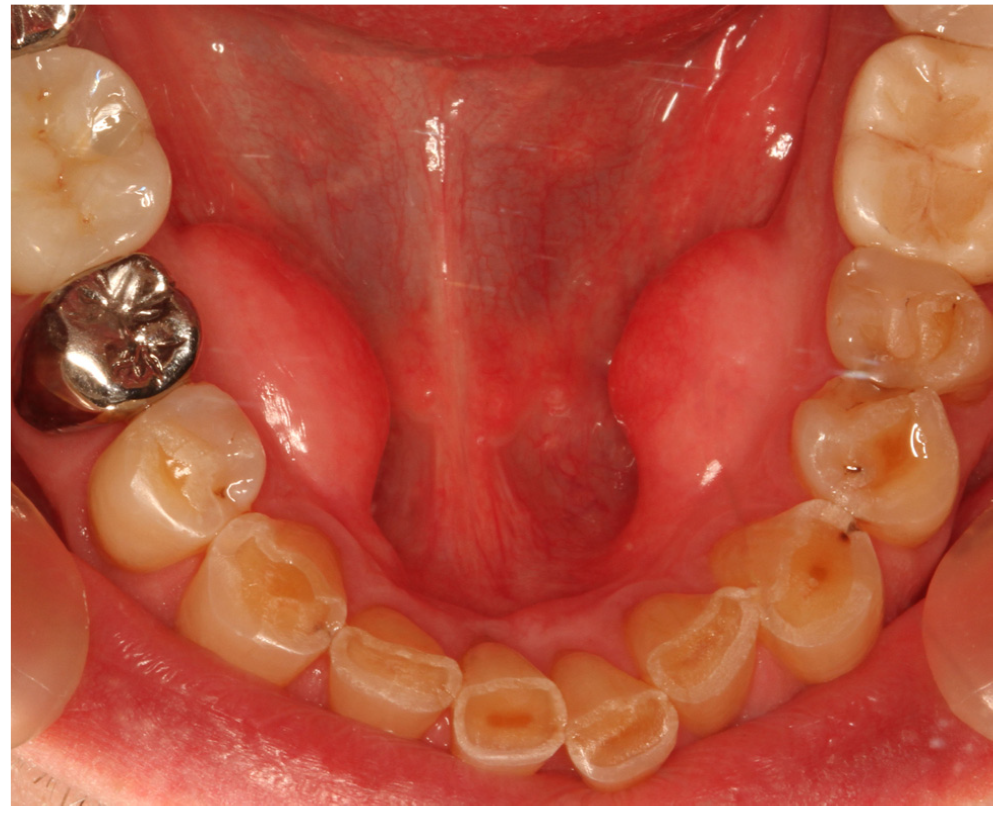 Toro Mandibular Fora Toro Mandibular Fora